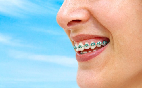 Ortodonti Tedavileri Nelerdir?