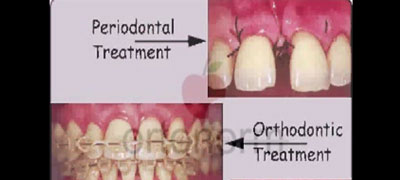 Ortodontik Tedaviye Ne Zaman Başlanmalı?