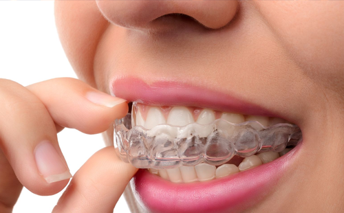 İnvisalign Tedavisi Yaptıranlar