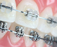 Ortodonti Tedavisine Nasıl Karar Verilir?