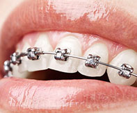 Ortodonti Tedavisinde Ağız Bakımı
