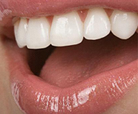 Çeşitli Lingual Ortodontik Tedaviler Hangileridir?