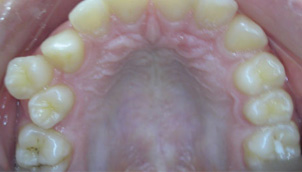 Ortonorm Ortodonti Önce Sonra