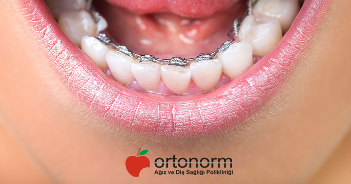 Ortodontik Bozukluk