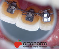 Ortodontik Tedavi Sırasında Yaşanabilecek Diş Eti Problemleri Nelerdir?