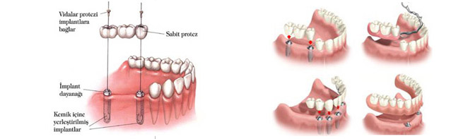 Ortonorm Diş İmplantları
