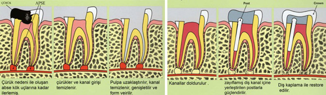 Ortonorm Endodonti Kanal Tedavisi