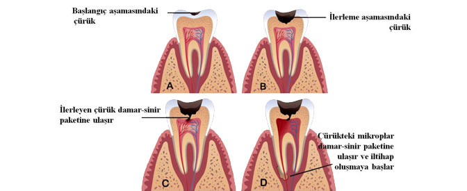 Ortonorm Endodonti Kanal Tedavisi