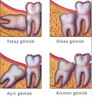 Ortonorm 20 Yaş Dişleri